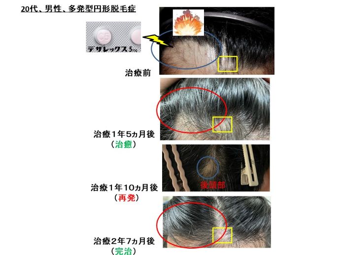 円形脱毛症　病院